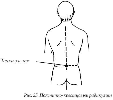 Карта вызова радикулопатия пояснично крестцового отдела