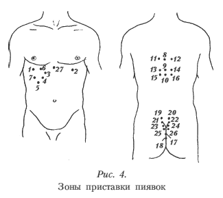 Схема лечения пиявками