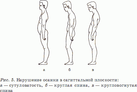 Как называется нарушение осанки изображенное на рисунке 3