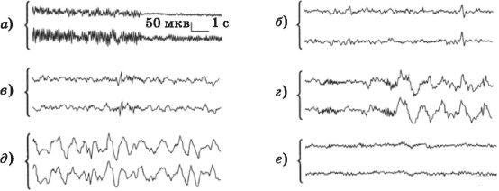 Рассмотрите рисунки изображающие электроэнцефалограммы спящего человека 206