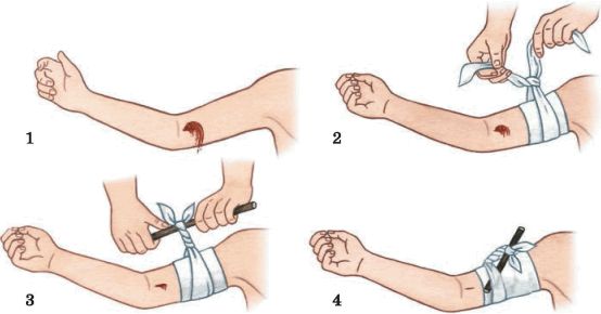 Помощь при кровотечении артерии