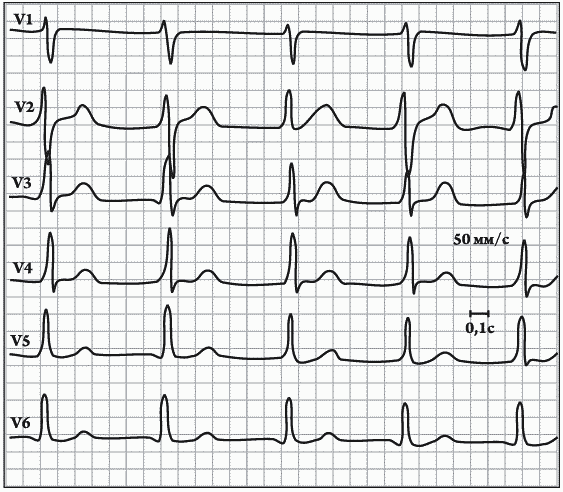 Синдром ранней реполяризации желудочков. Реполяризация миокарда желудочков ЭКГ. Ранняя реполяризация желудочков на ЭКГ. Синдром ранней реполяризации желудочков на ЭКГ. ЭКГ при синдроме ранней реполяризации желудочков.