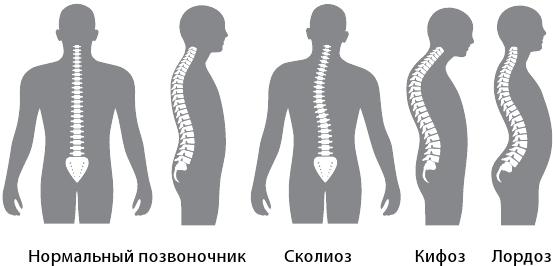 Тут выгнувши хребет и понатужа автор. Искривление позвоночника лордоз кифоз сколиоз. Искривление позвоночника лагдох сктфох.